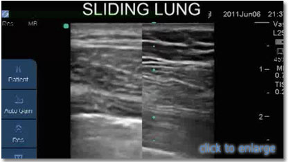 Teleflex Ultrasound Guided Venous Access Complliance Within Practice