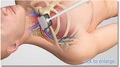 ij right ultrasound probe position