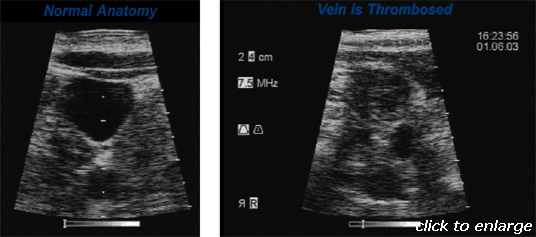 vein normal vs thrombosed