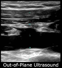 out of plane ultrasound