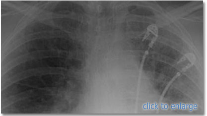 pneumothorax xray