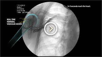 Proximal Humerus Infusion Fluoroscopy video image