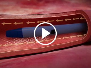 Catheter-to-Vessel Ratio (CVR) Video