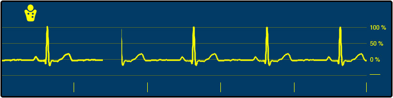 GIT_3-1-1_External-ECG